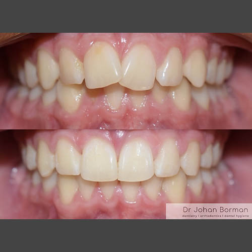 Orthodontic treatment before and after treatment