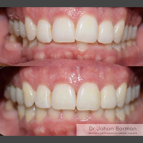 Orthodontic treatment before and after treatment
