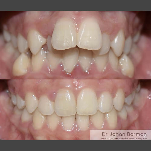 Orthodontic treatment before and after treatment