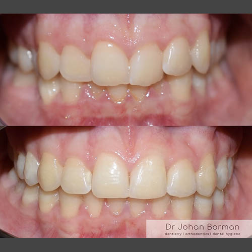 Orthodontic treatment before and after treatment