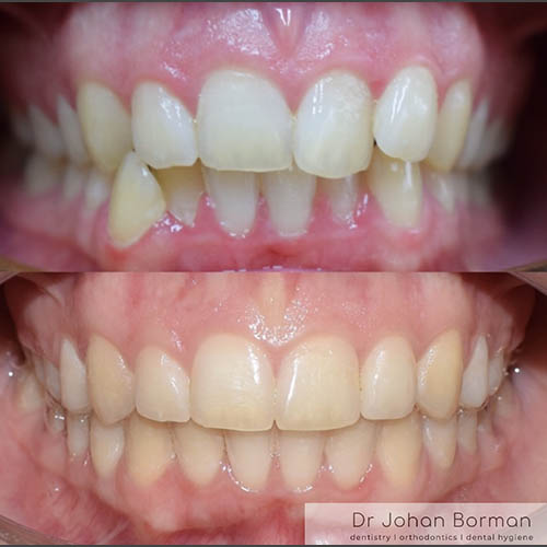 Orthodontic treatment before and after treatment