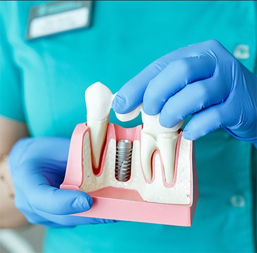 Dental Implants in Cape Winelands Dental Implants in Cape Winelands